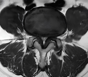 estenosis del canal lumbar doctor emilio gonzález neurocirujano (4)