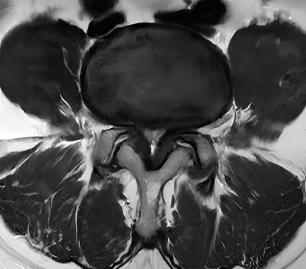 estenosis del canal lumbar doctor emilio gonzález neurocirujano (4)