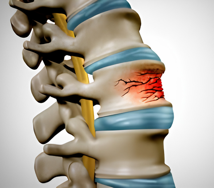 fracturas vertebrales doctor emilio gonzález neurocirujano (1)