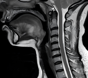 hernia discal cervical doctor emilio gonzález neurocirujano (2)