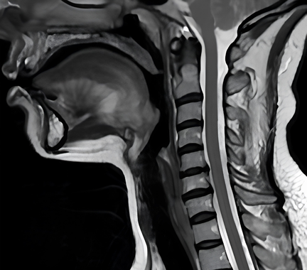 hernia discal cervical doctor emilio gonzález neurocirujano (2)