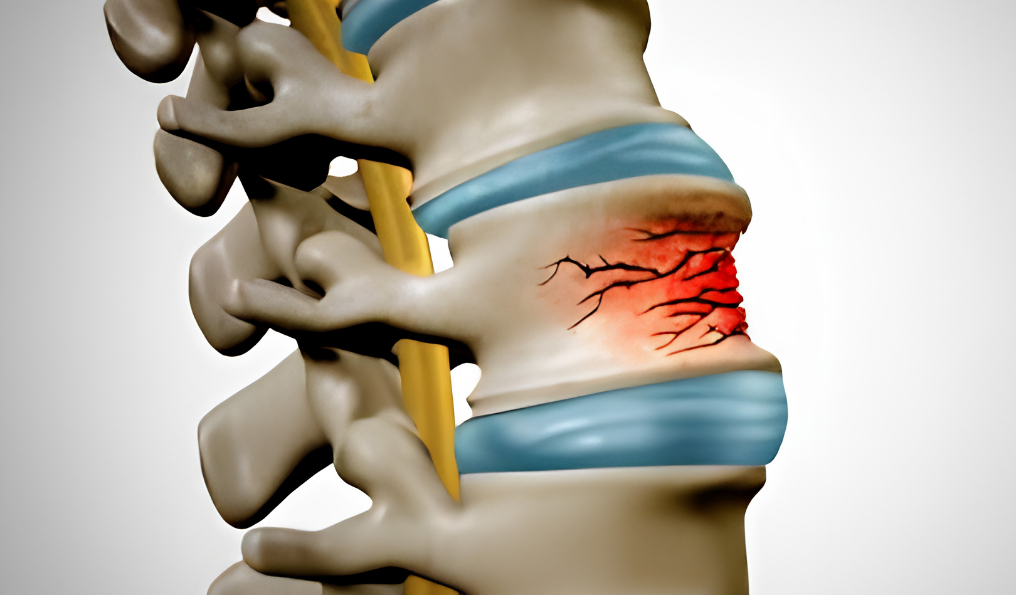fracturas vertebrales doctor emilio gonzález neurocirujano