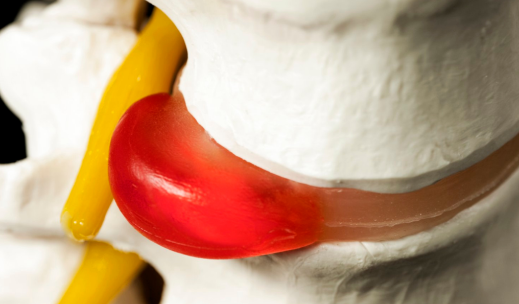 hernia discal lumbar​ doctor emilio gonzález neurocirujano